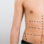 liposuction in bangalore