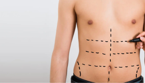 Reshape Your Confidence: Liposuction in Bangalore